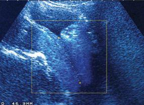 ​حالات الإجهاض المتكرر 